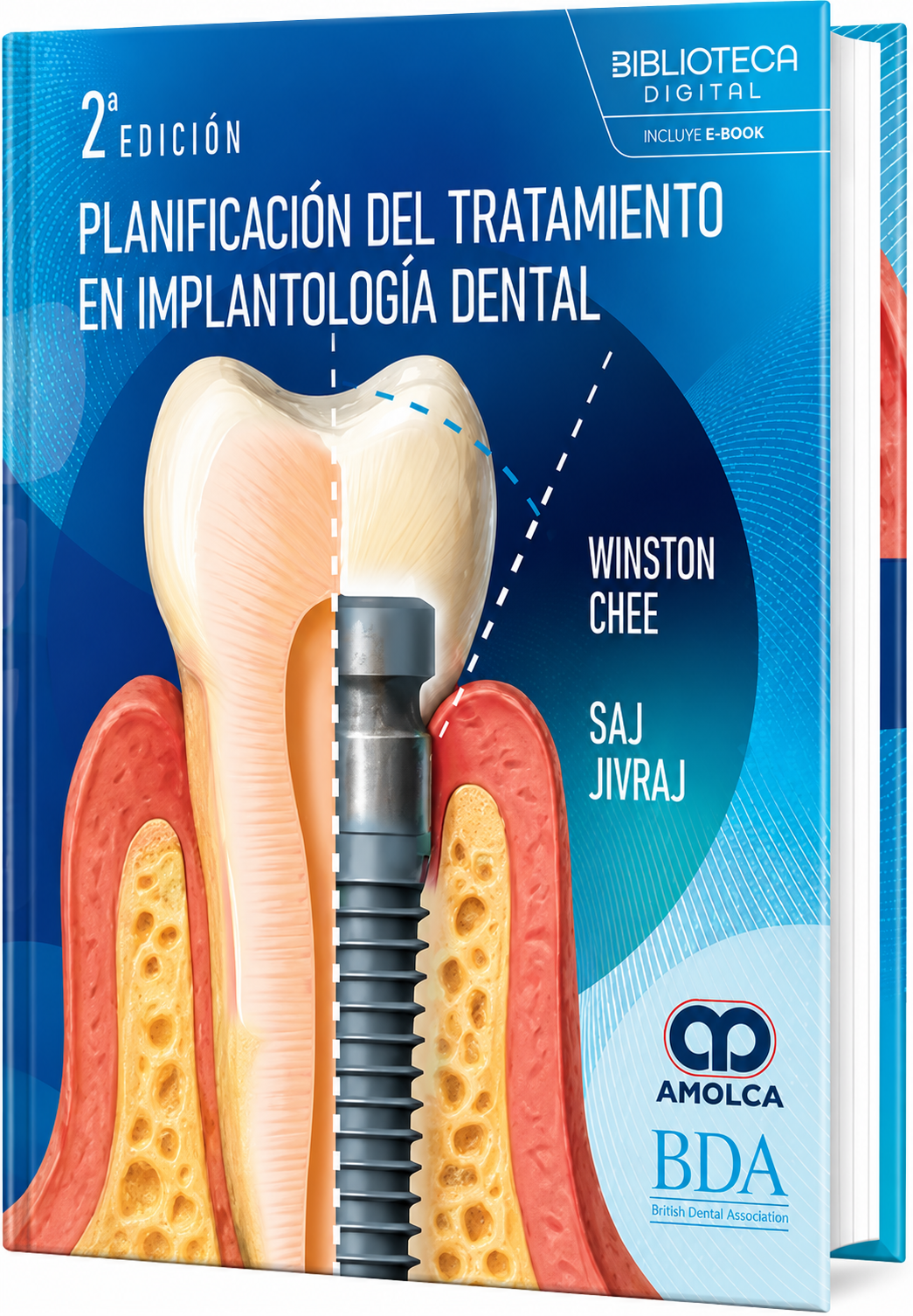 Planificación del tratamiento en implantología dental