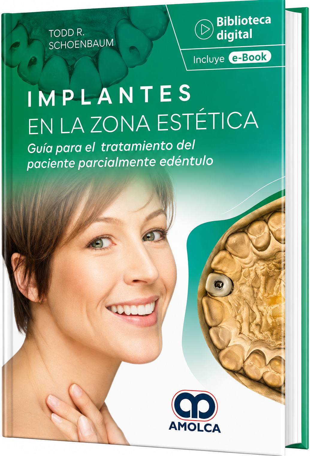 Implantes en la zona estética